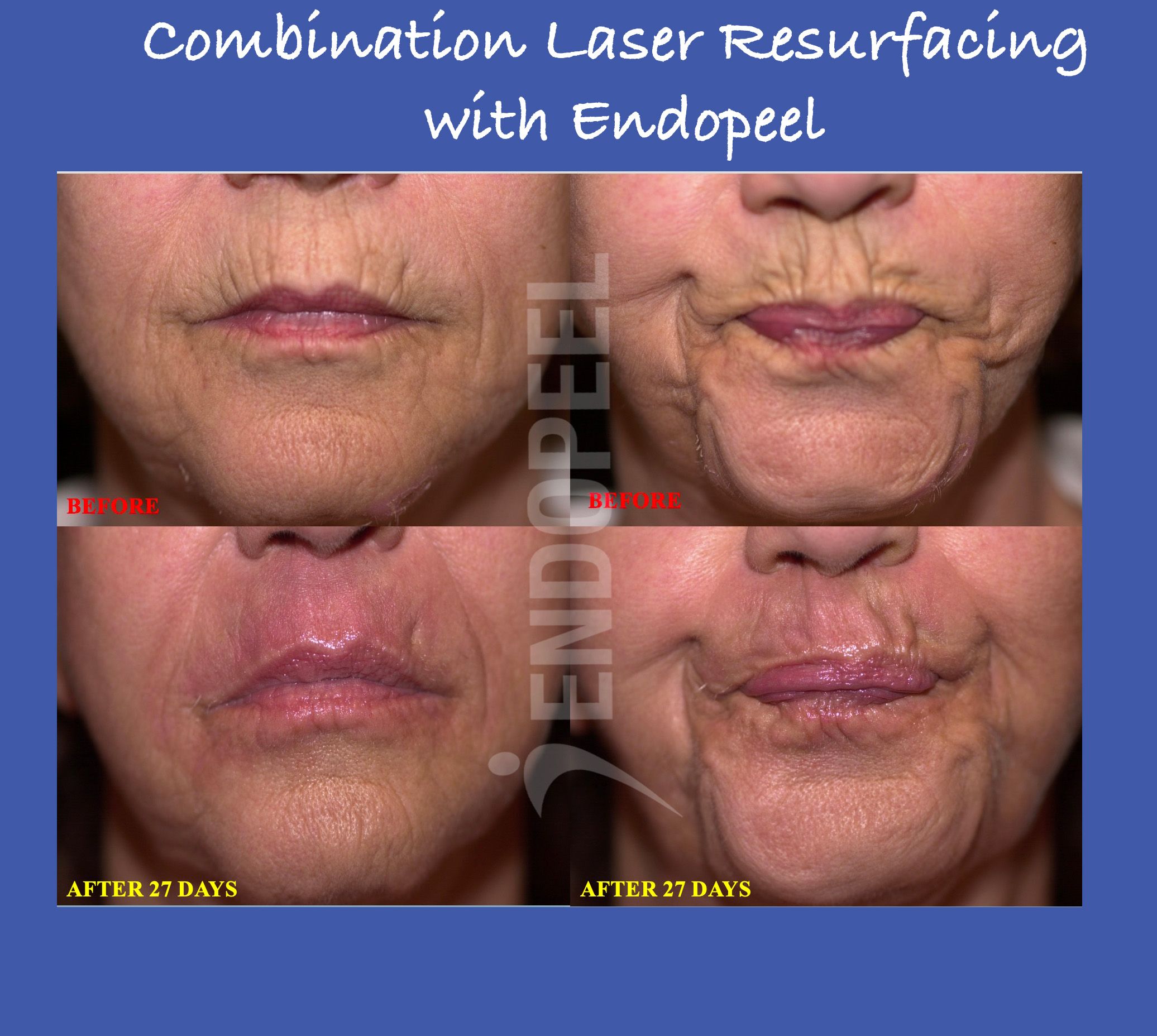 Combination-laser-endopeel1