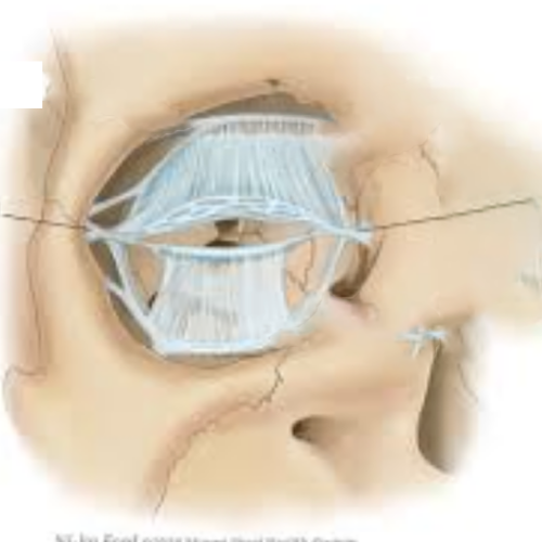 lateral canthal ligament