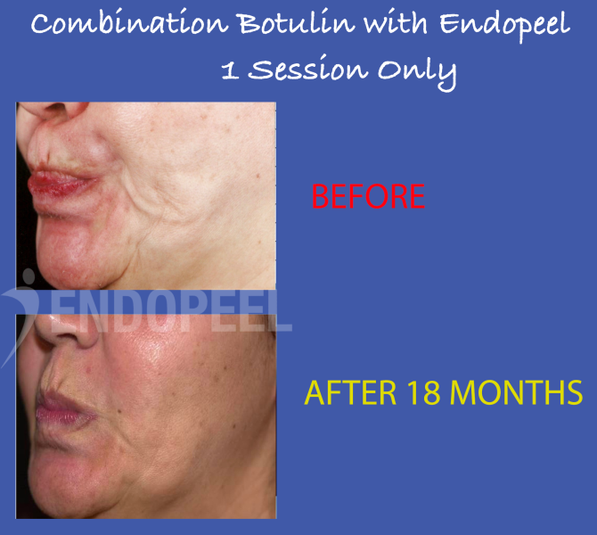 combination-botox-endopeel1