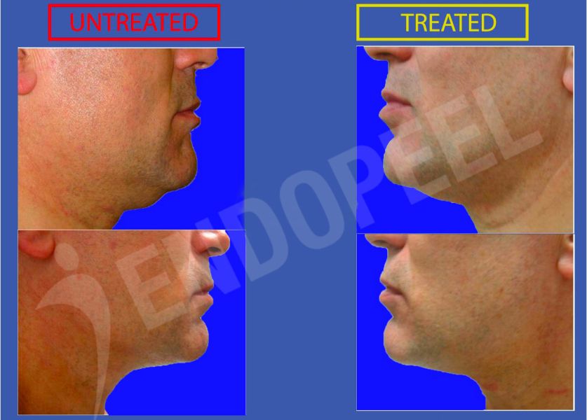 double chin treated with Endopeel