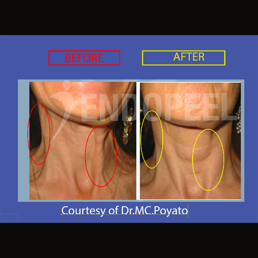 monocordal platysma band