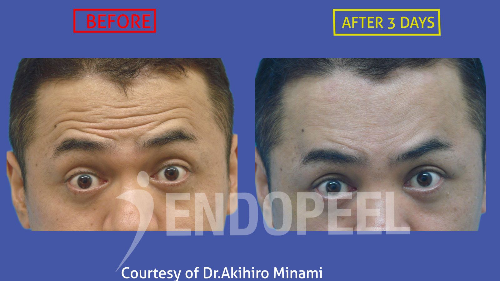 UPPER THIRD2-endopeel