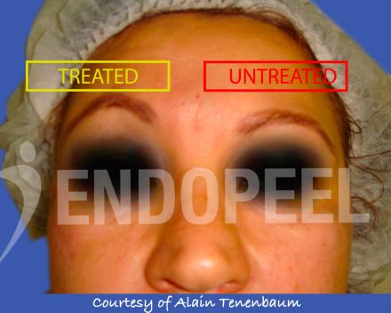 eyebrowlift-endopeel