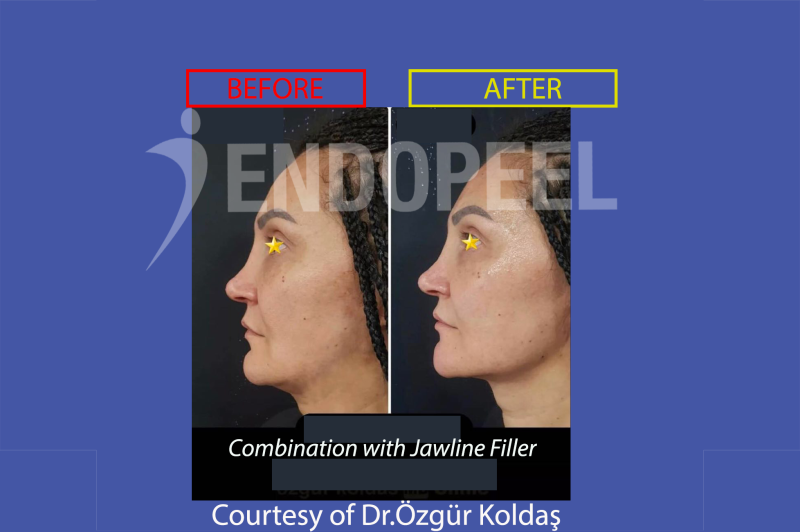 combination endopeel-jawline filler