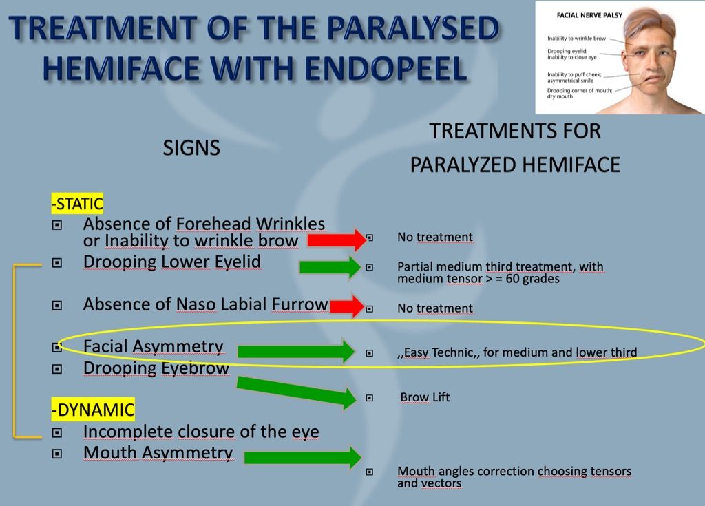 facial asymmetry