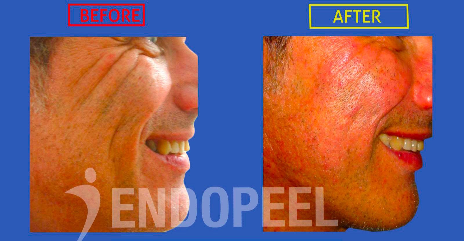 deep-acne-folds-treatment-endopeel