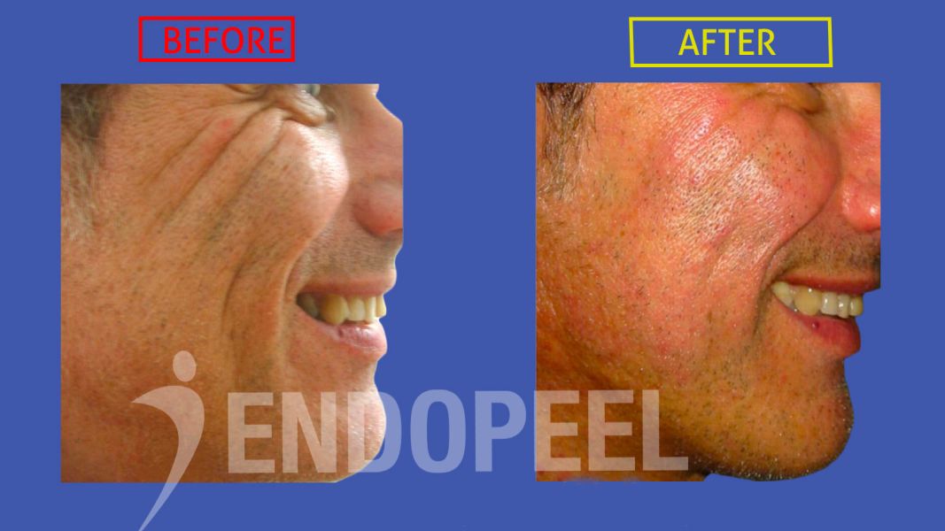 acne-facial-folds-endopeel