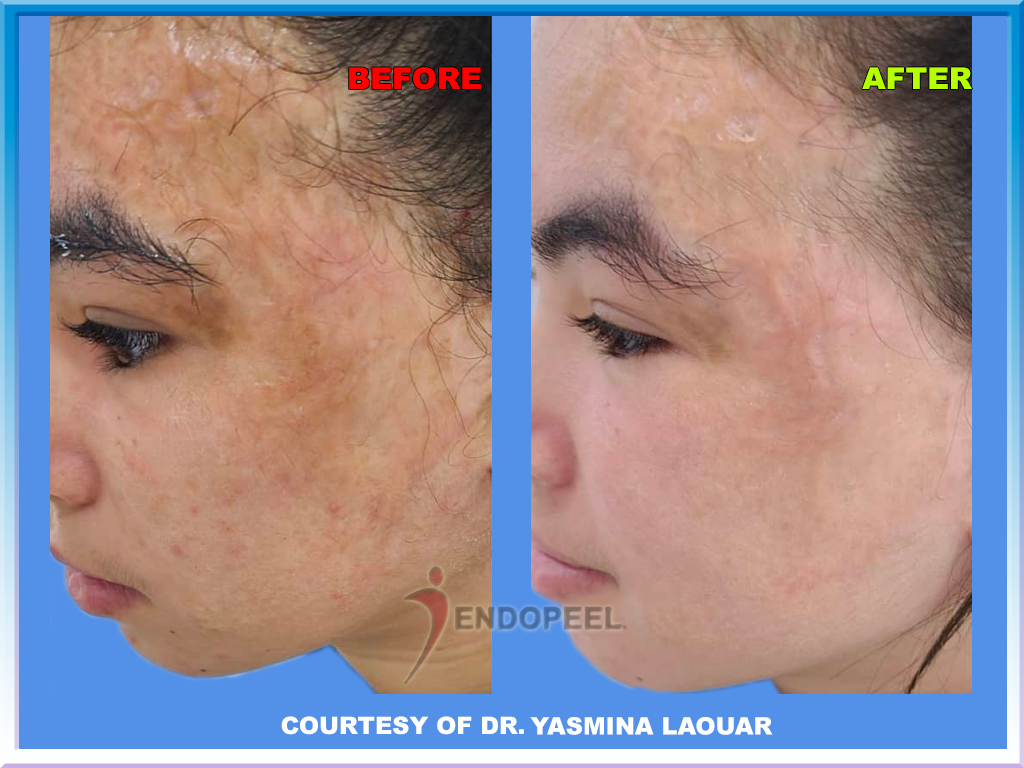 sequelae of facial burns treated with Endopeel + Peeling de Luxe + 30 min Peel Off