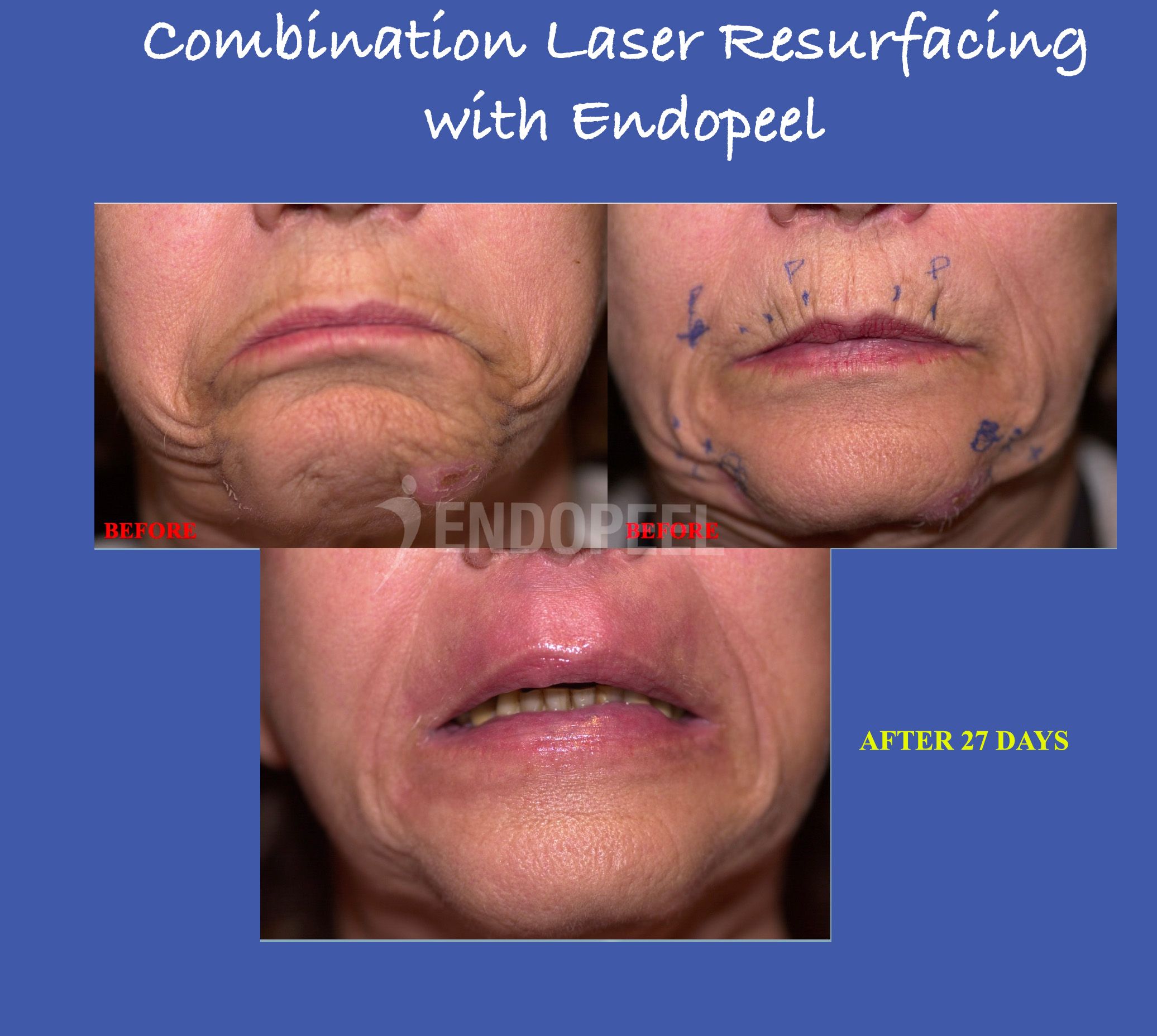 combination-laser-endopeel3