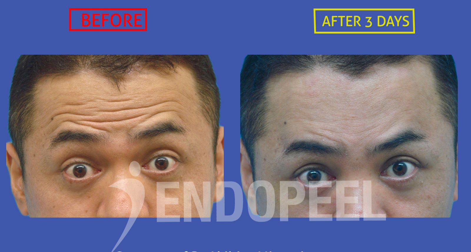 upper-third-endopeel