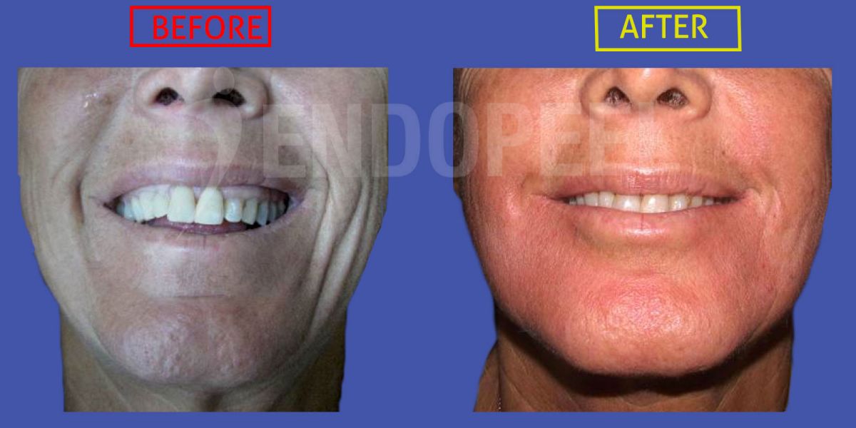 LOWER-THIRD3-endopeel