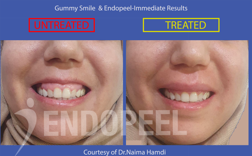 gummy smile-naima hamdi