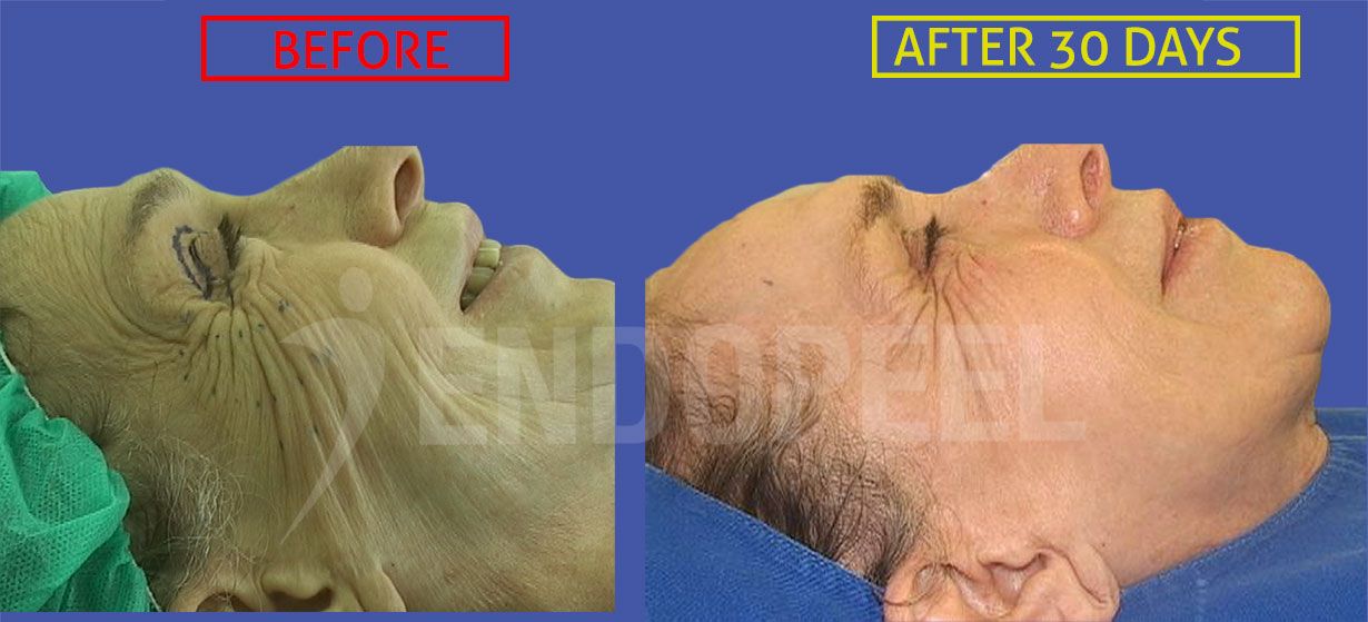 endopeel-wrinkles-old-female