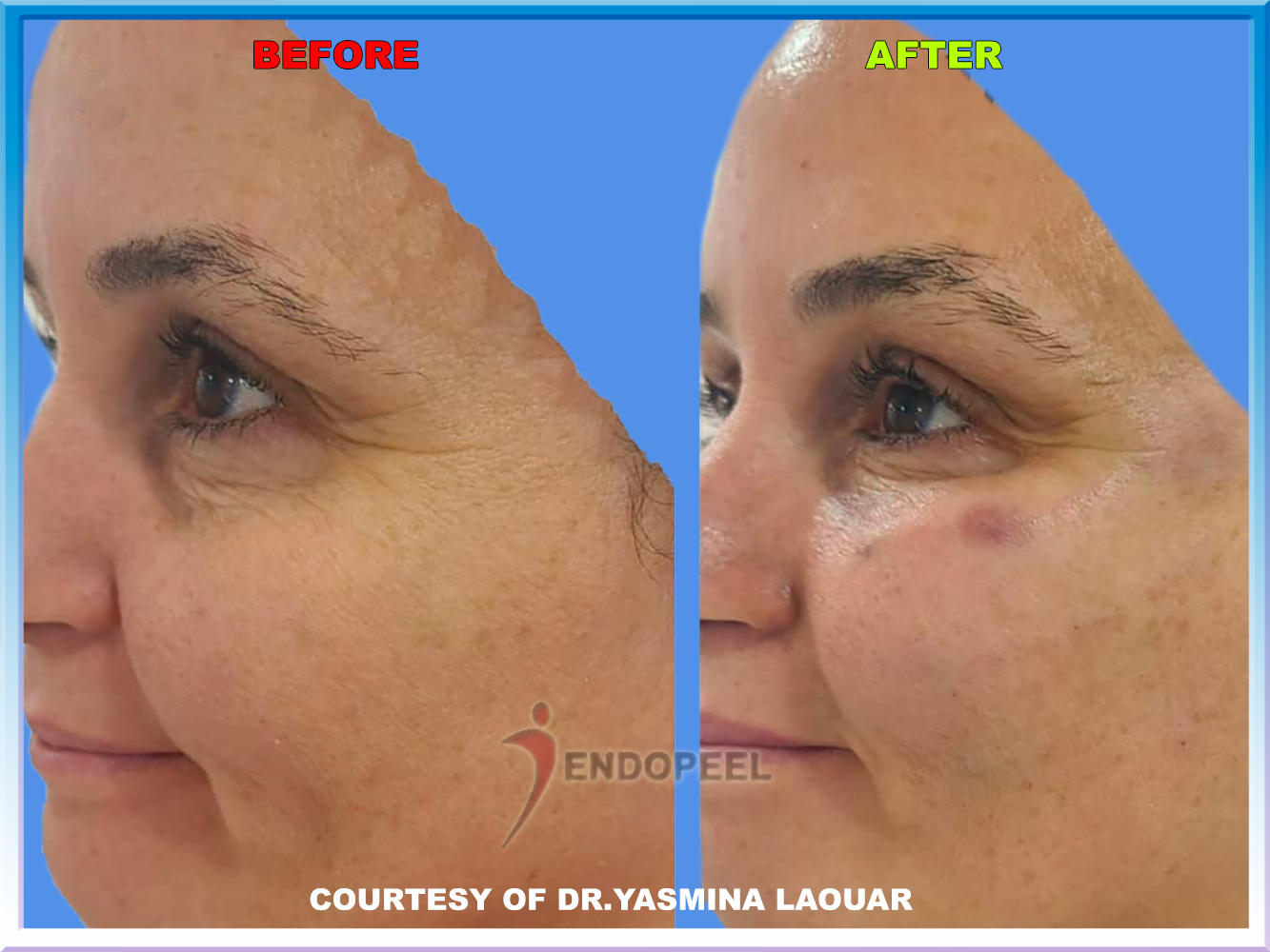 Periocular Wrinkles treated with Endopeel + Peeling de Luxe + 30 min Peel Off