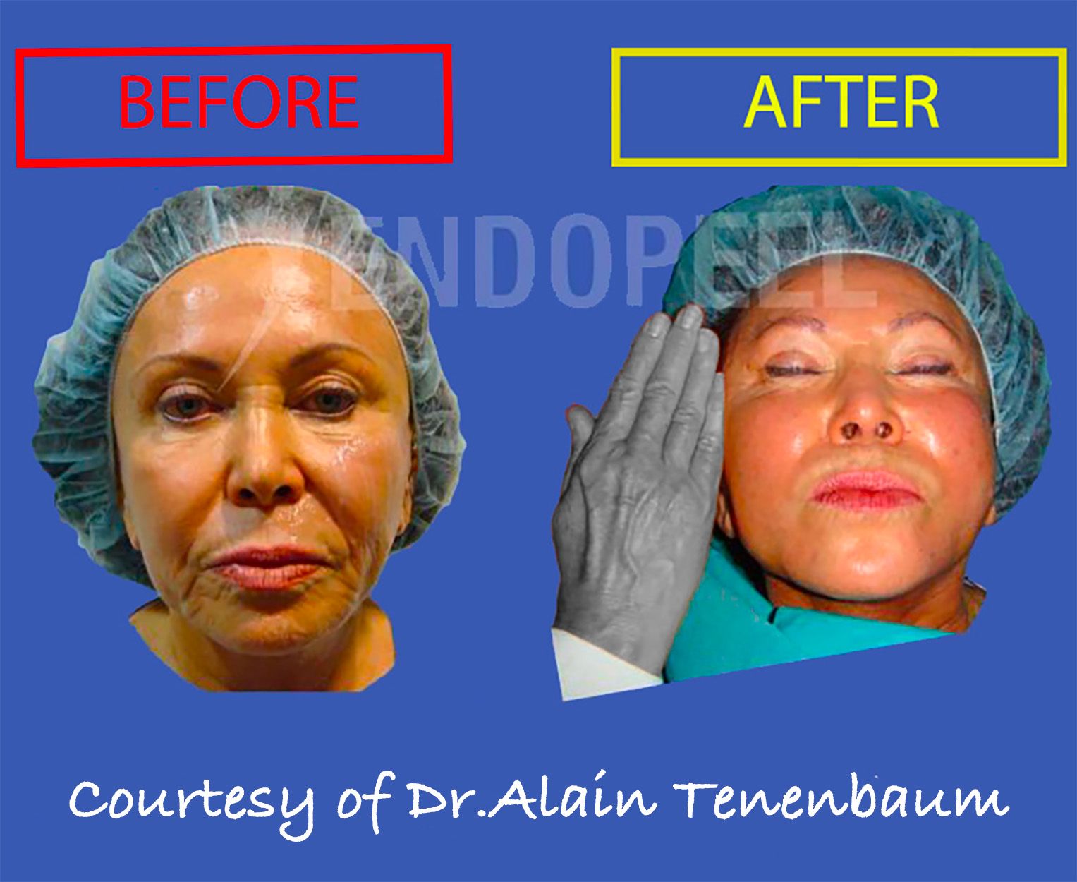 immediate-facecontour-endopeel-vs-hands