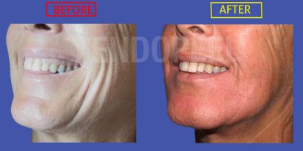 LOWER-THIRD-endopeel