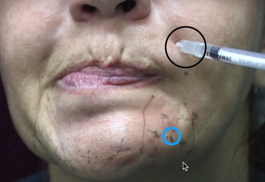 where-endopeel-botulinum-injections