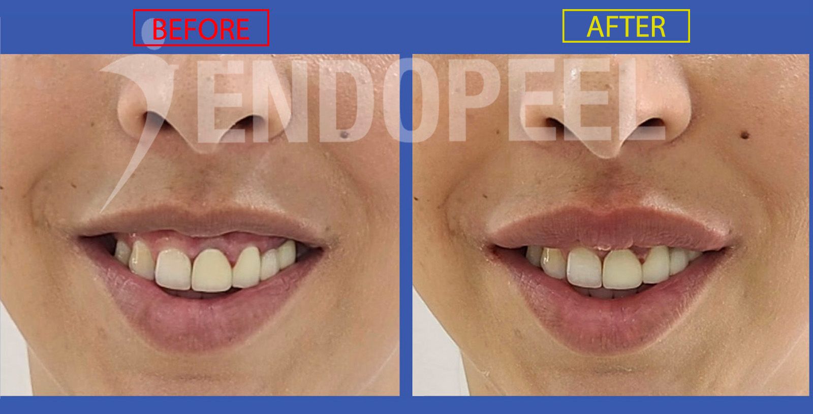 gummy-smile-treatment-endopeel