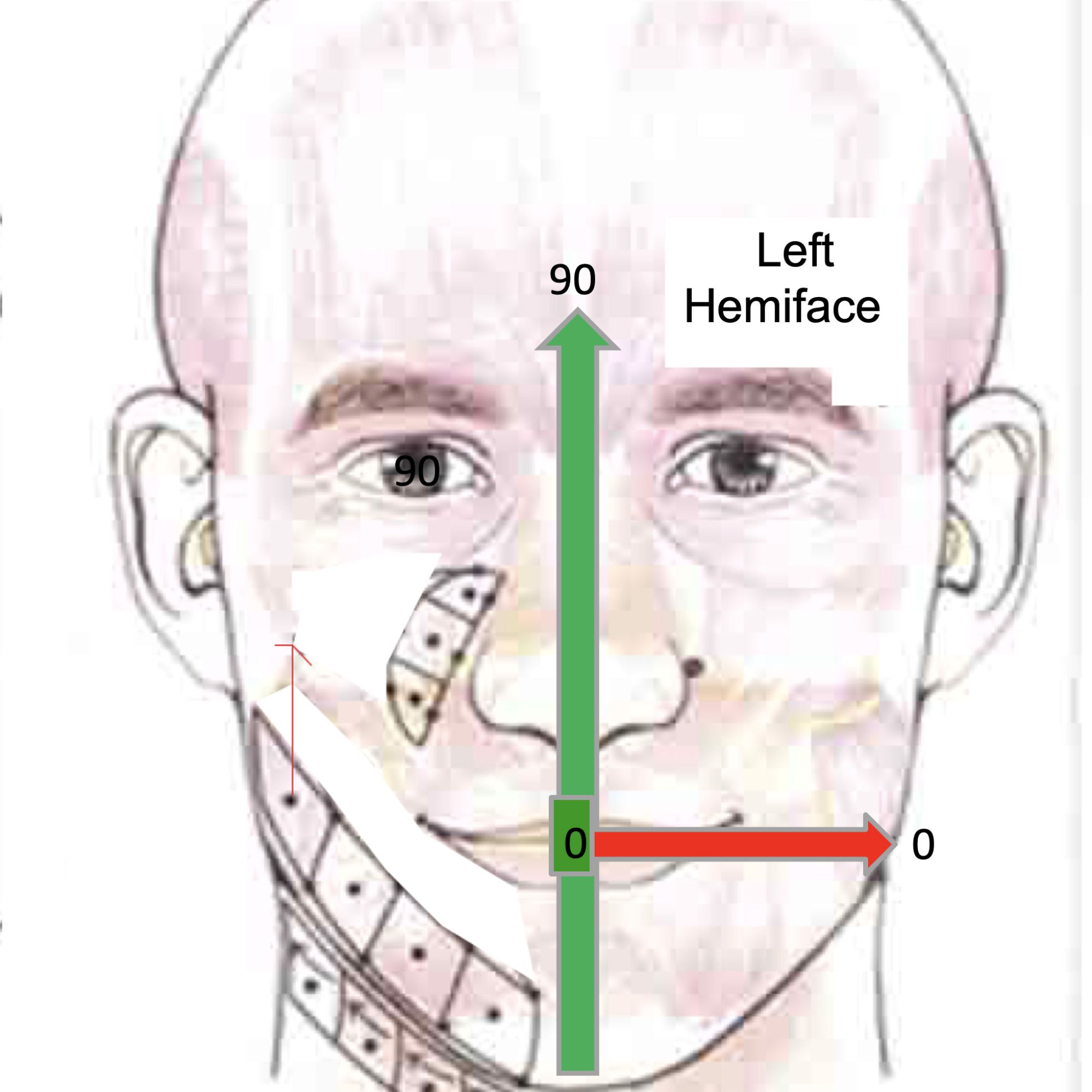 summary left hemiface