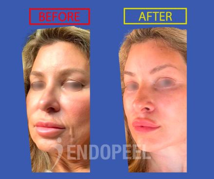 middle-third-anti-aging-female-40years-endopeel