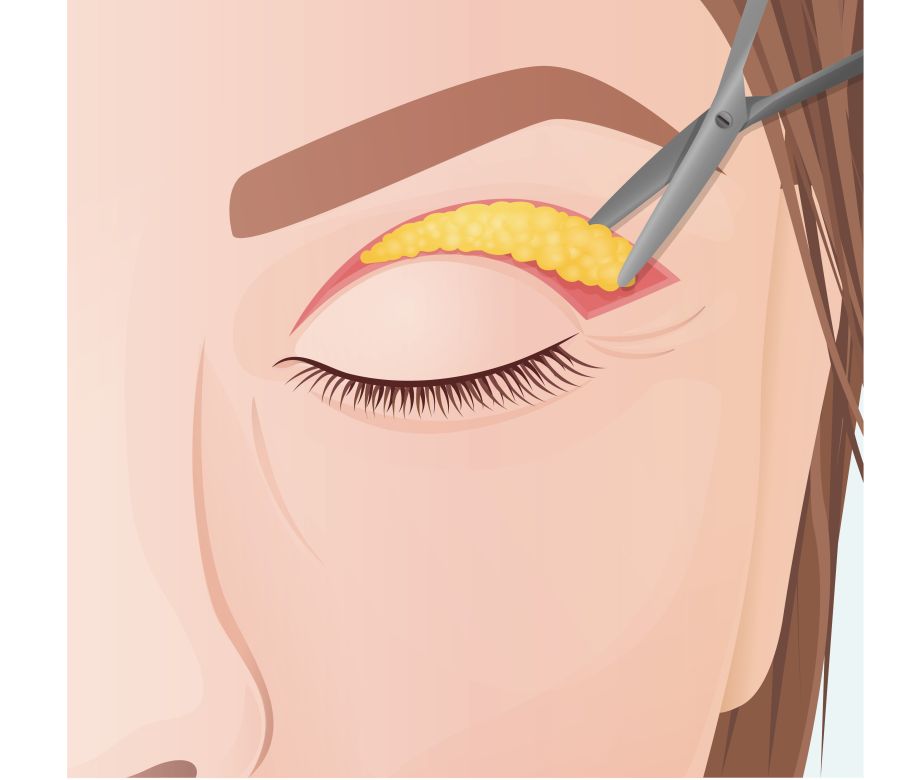 herniated fat upper eyelid