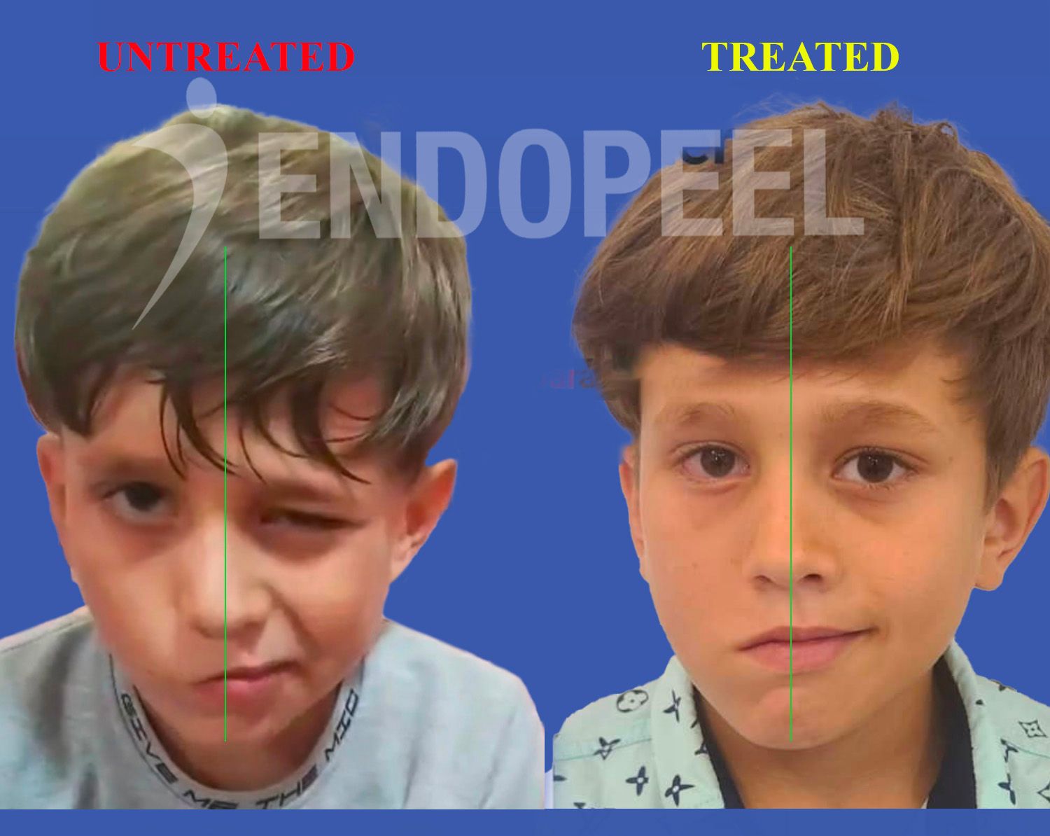 facial-paralysis-treatment-endopeel