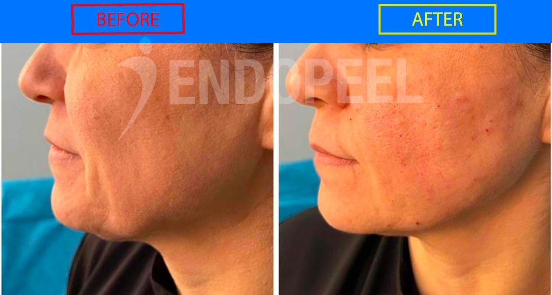 marionette-left-profile-endopeel