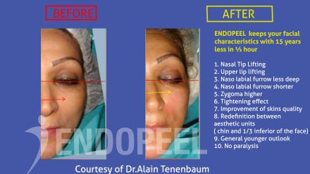 MIDDLE-THIRD2-endopeel.