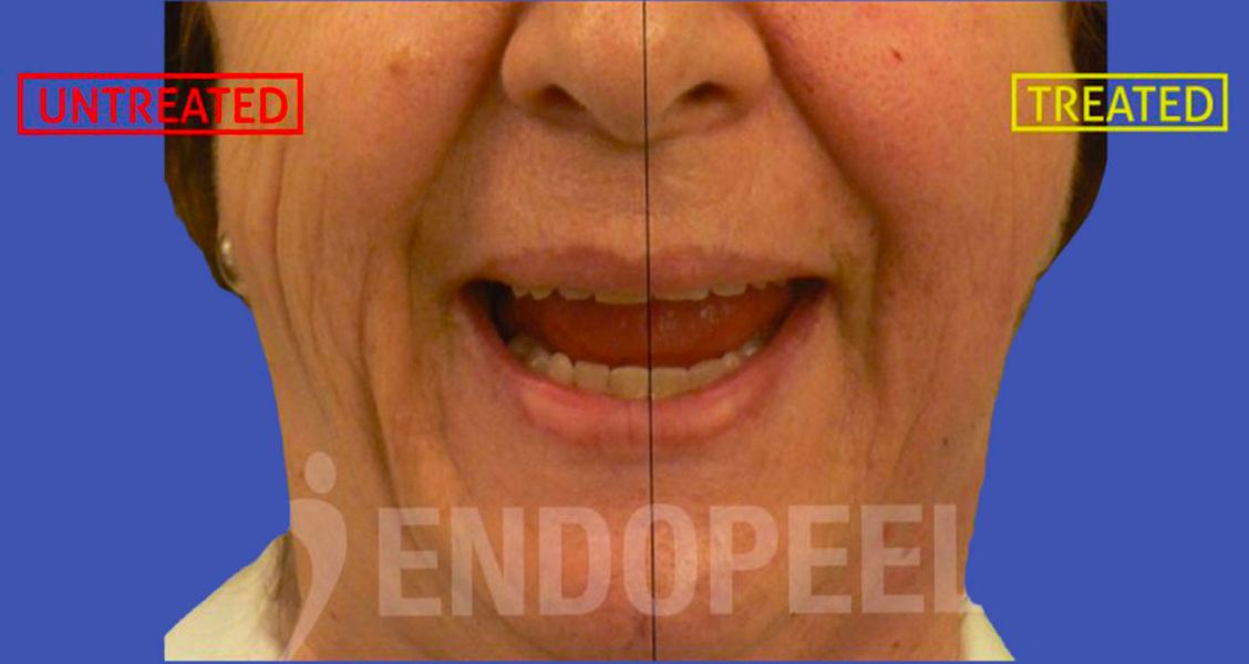 lower-third-endopeel-mouth-depressors