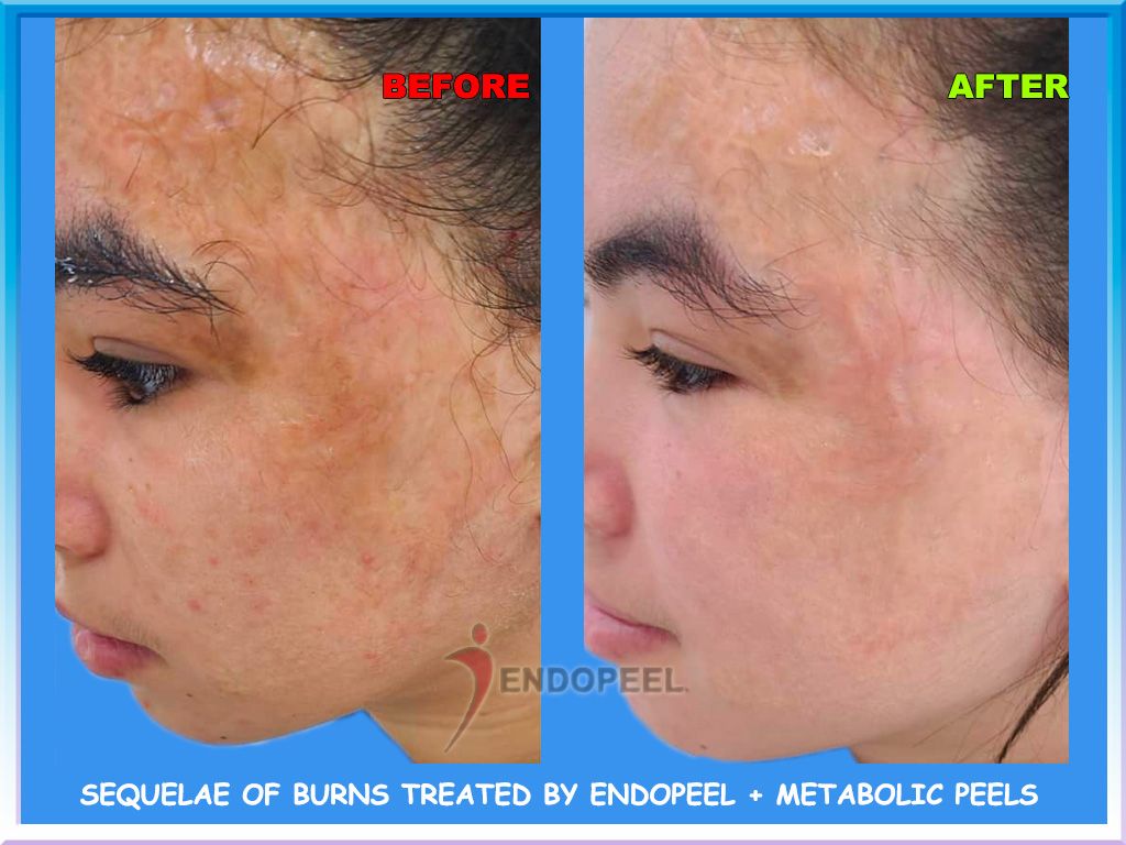 sequelae-burns-endopeel