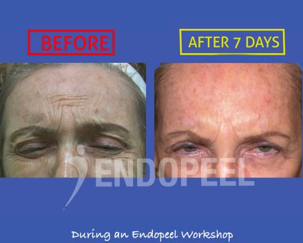 female-forehead-wrinkles-endopeel-eyes-closed