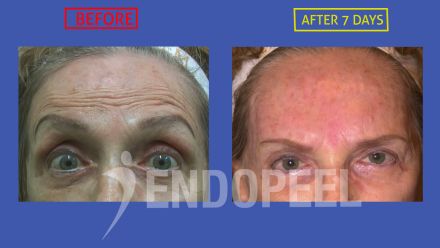 emale-forehead-wrinkles-eyes-up