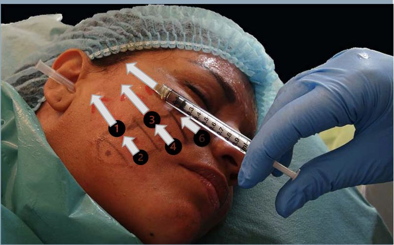 the 6 tensors for NLF