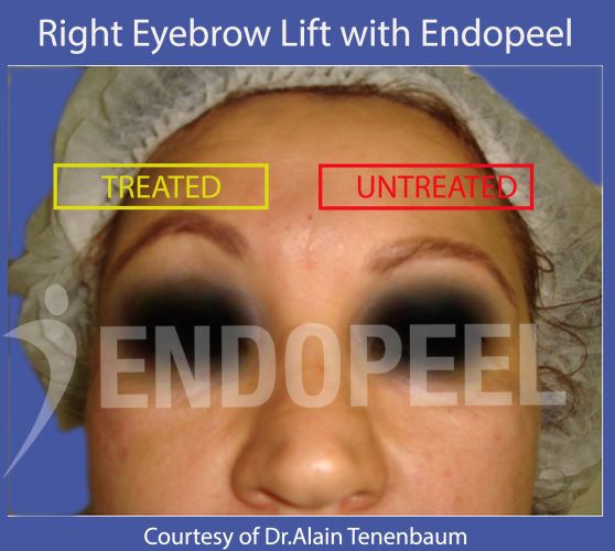 upper-eyelid-lift-endopeel