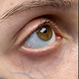 lower-eyelid-veins
