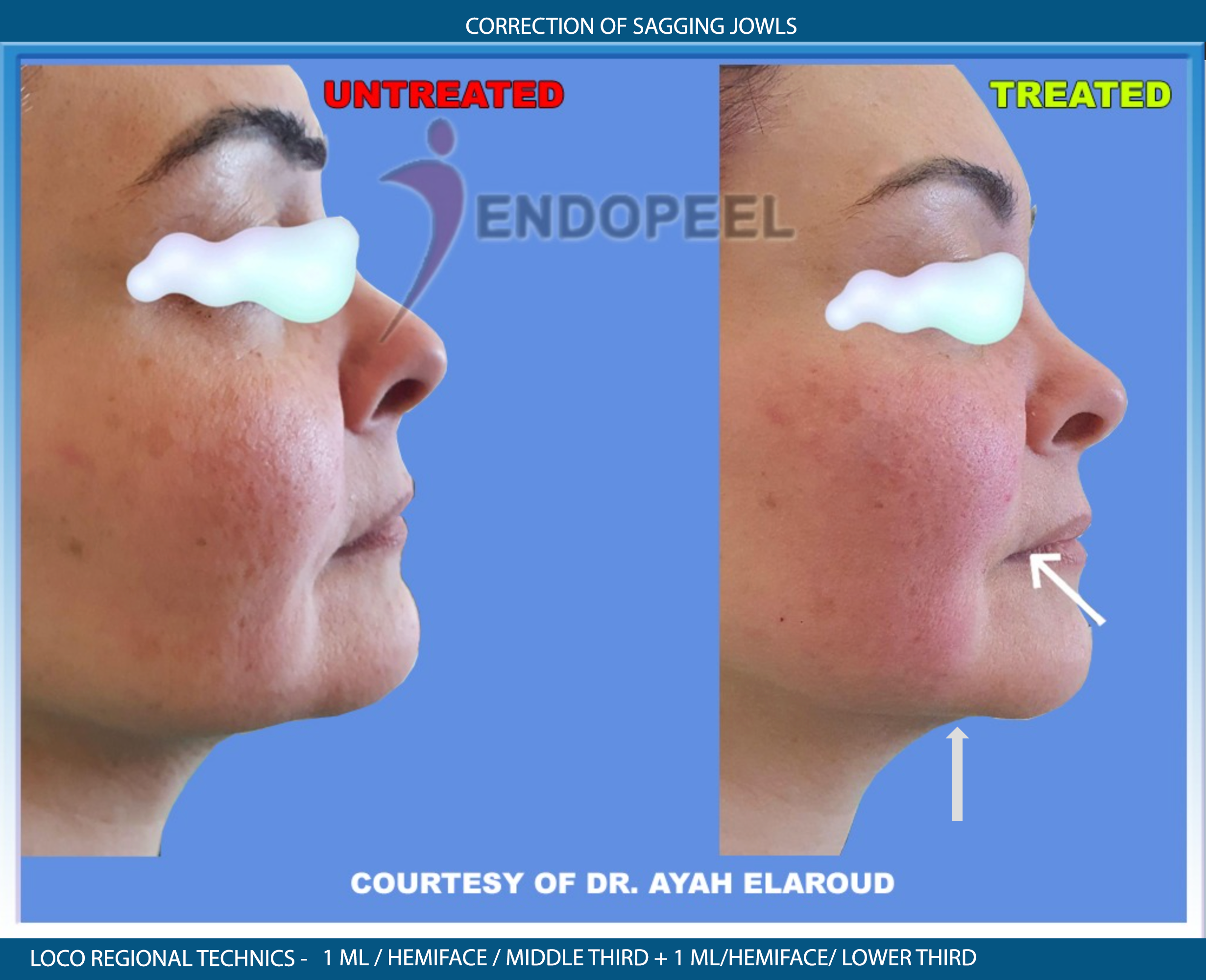 sagging face by Dr.Aya Elaroud