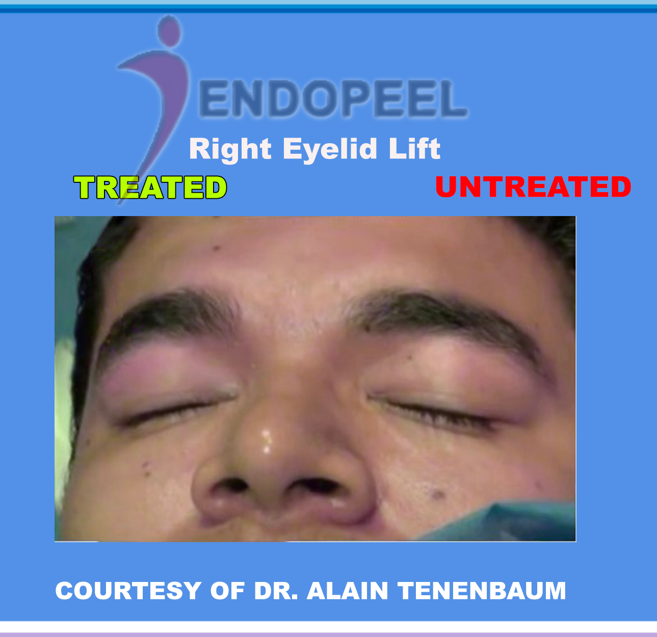 R-eyelid-lift-closedeye-endopeel