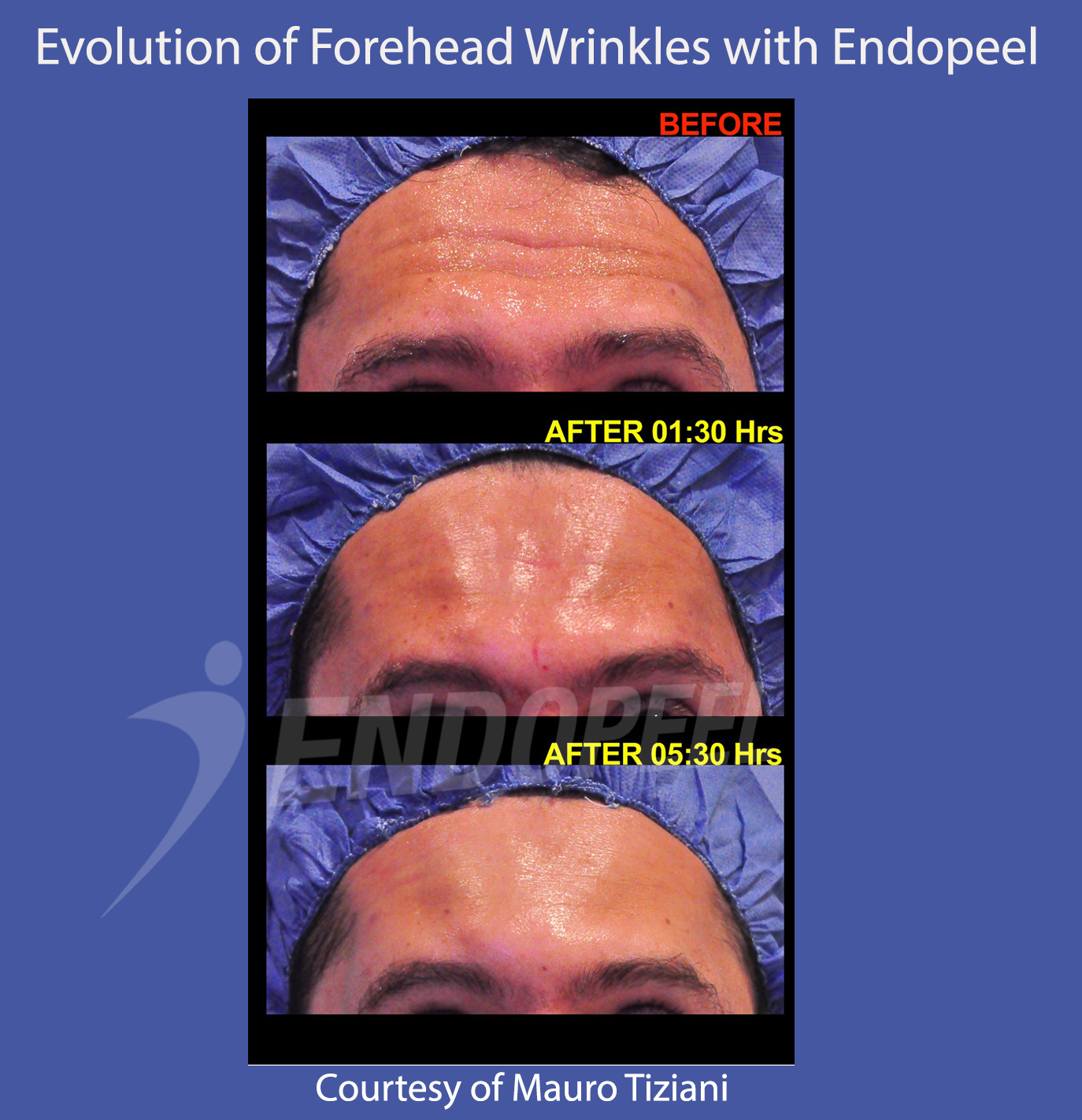 evolution-forehead-wrinkles-endopeel