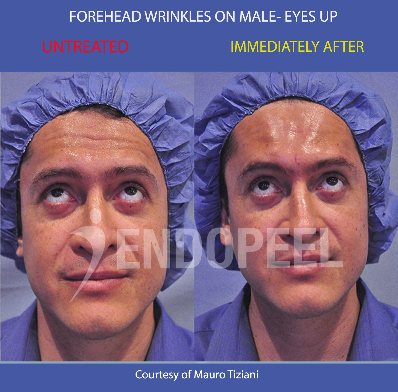 forehead-wrinkles-male-eyesup.jpg