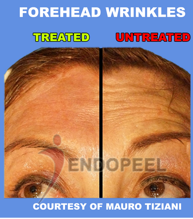 forehead-wrinkles-endopeel-1-clinic