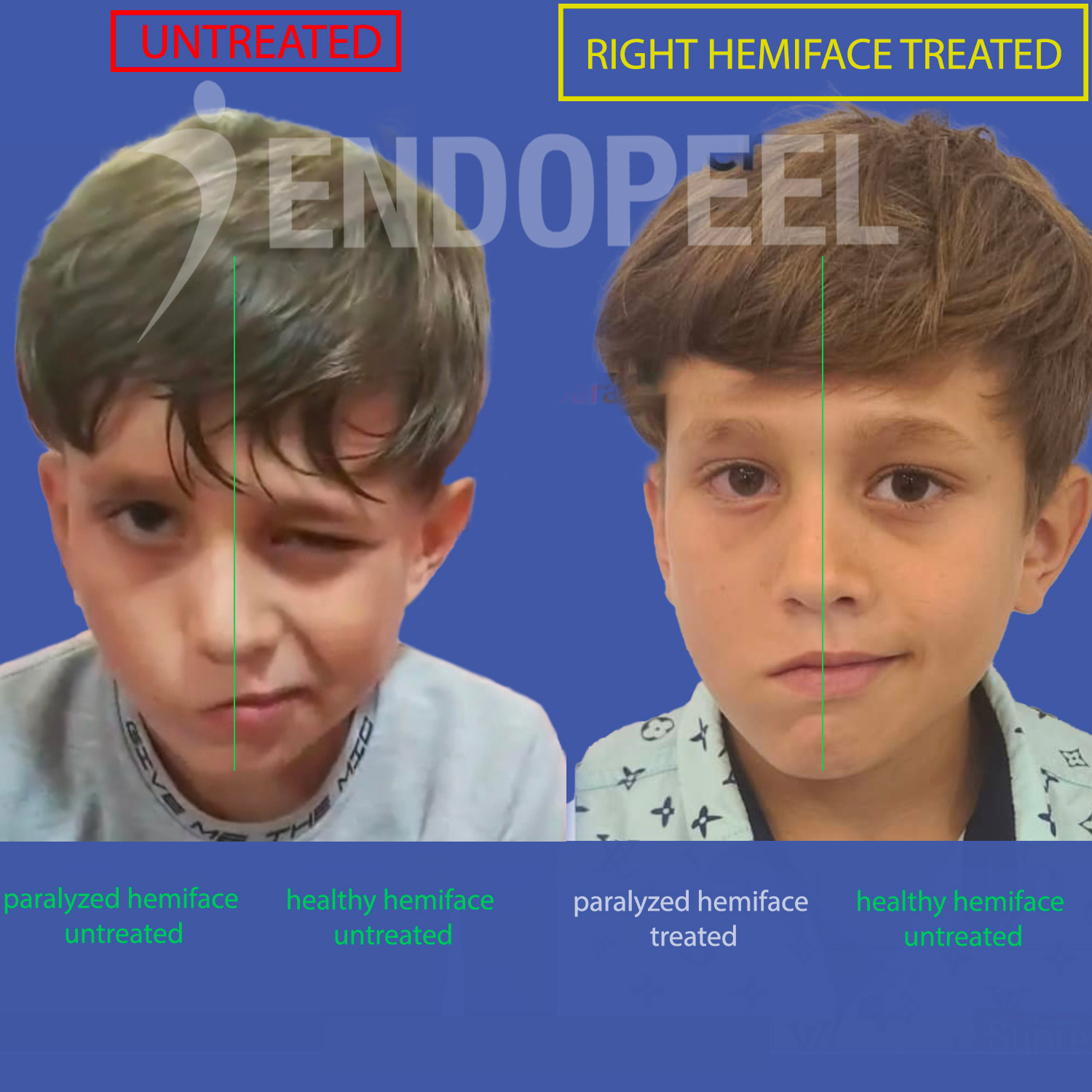 PF-child-endopeel-1