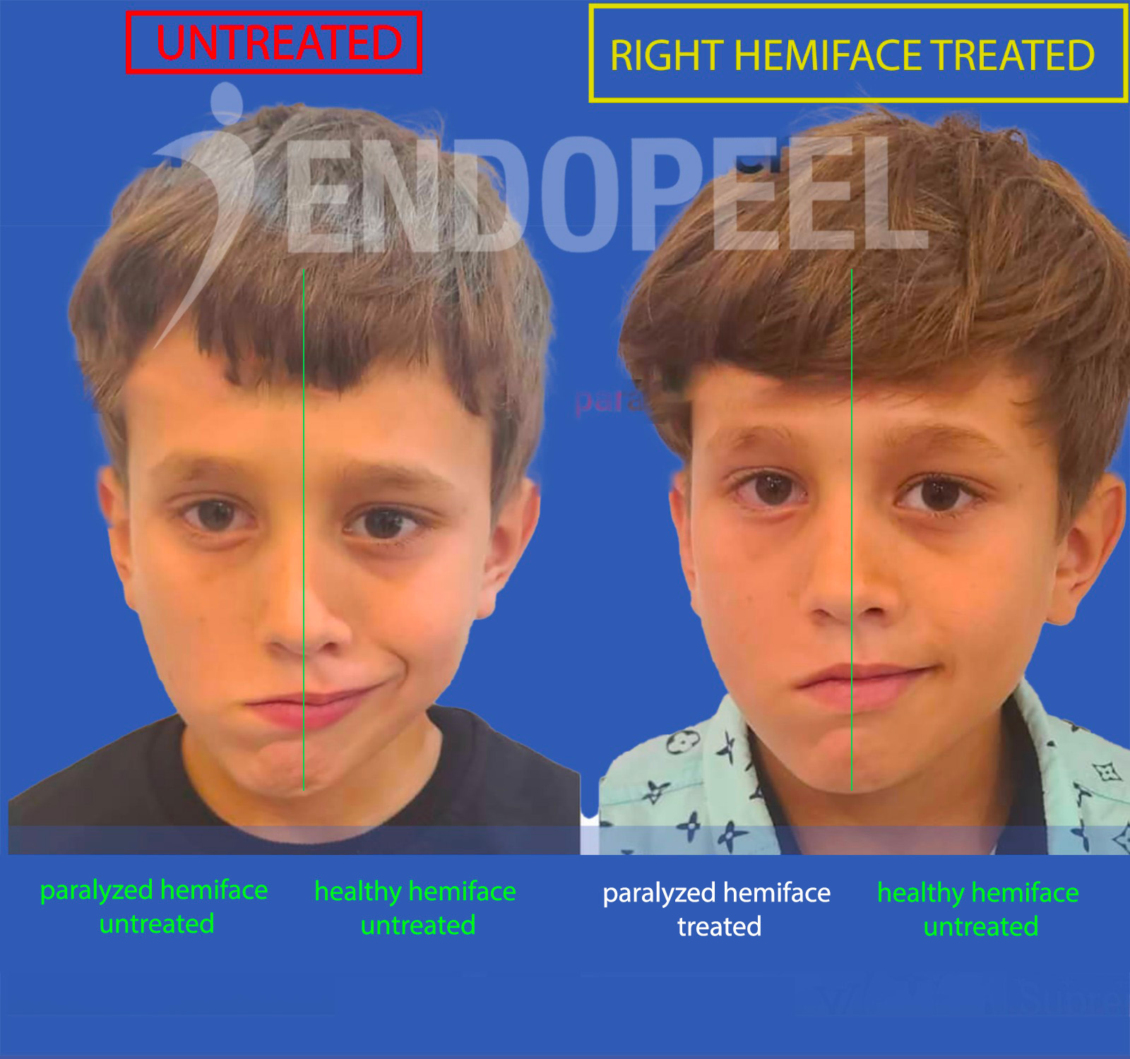 PF-child-endopeel-2