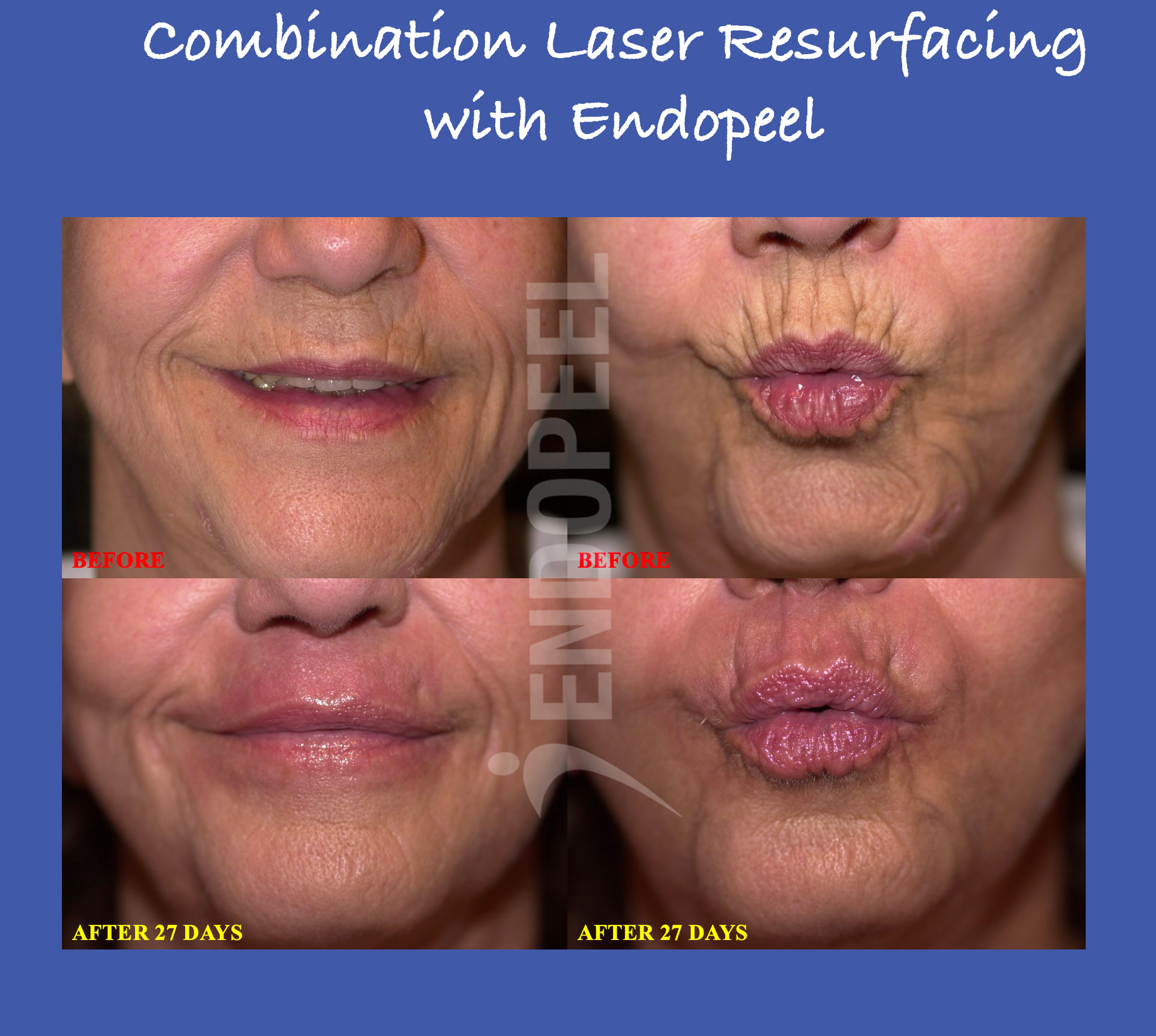 combination-laser-endopeel2