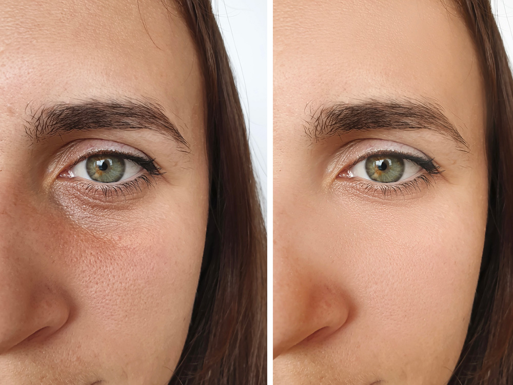 tear-trough-depression