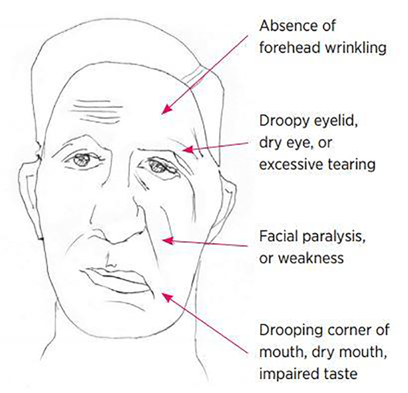 Sequellae of Facial Paralysis