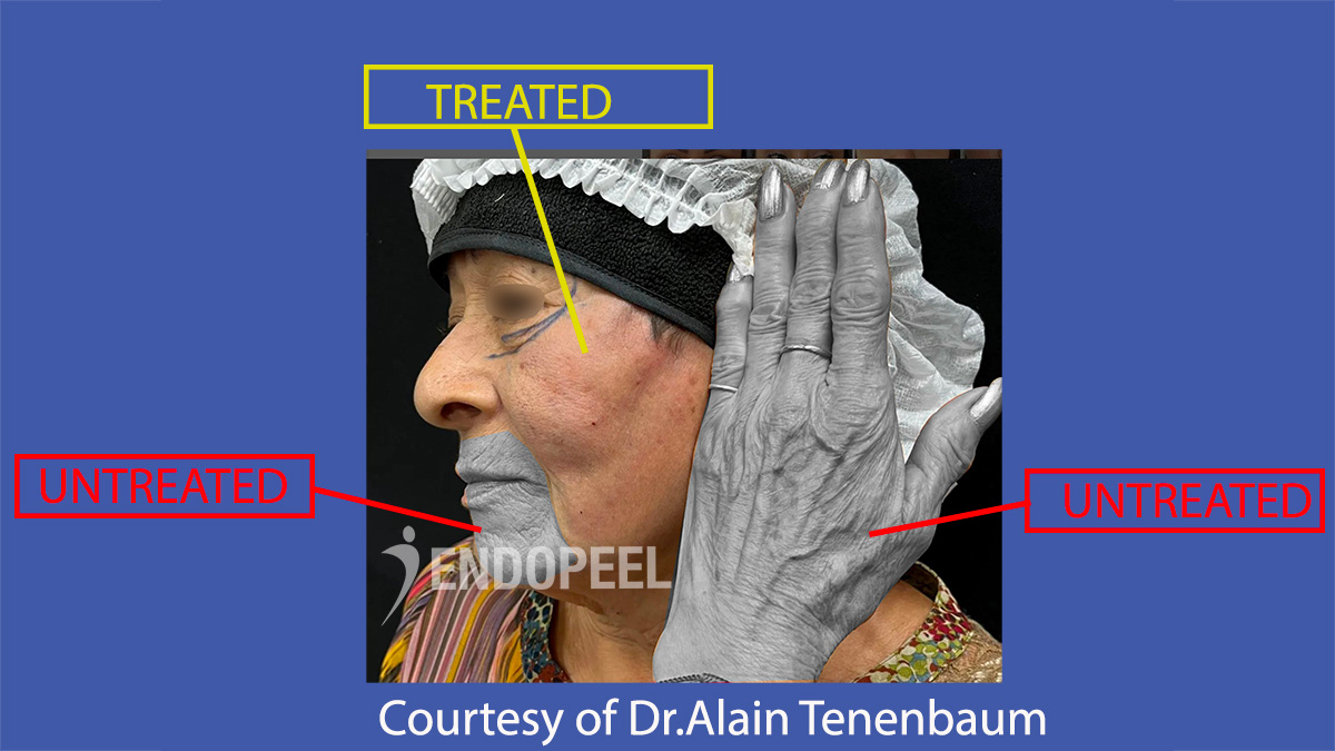 fake-turkish-woman-face-treated