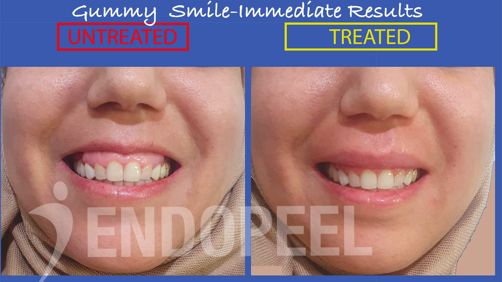 gummysmile-naima-hamdi