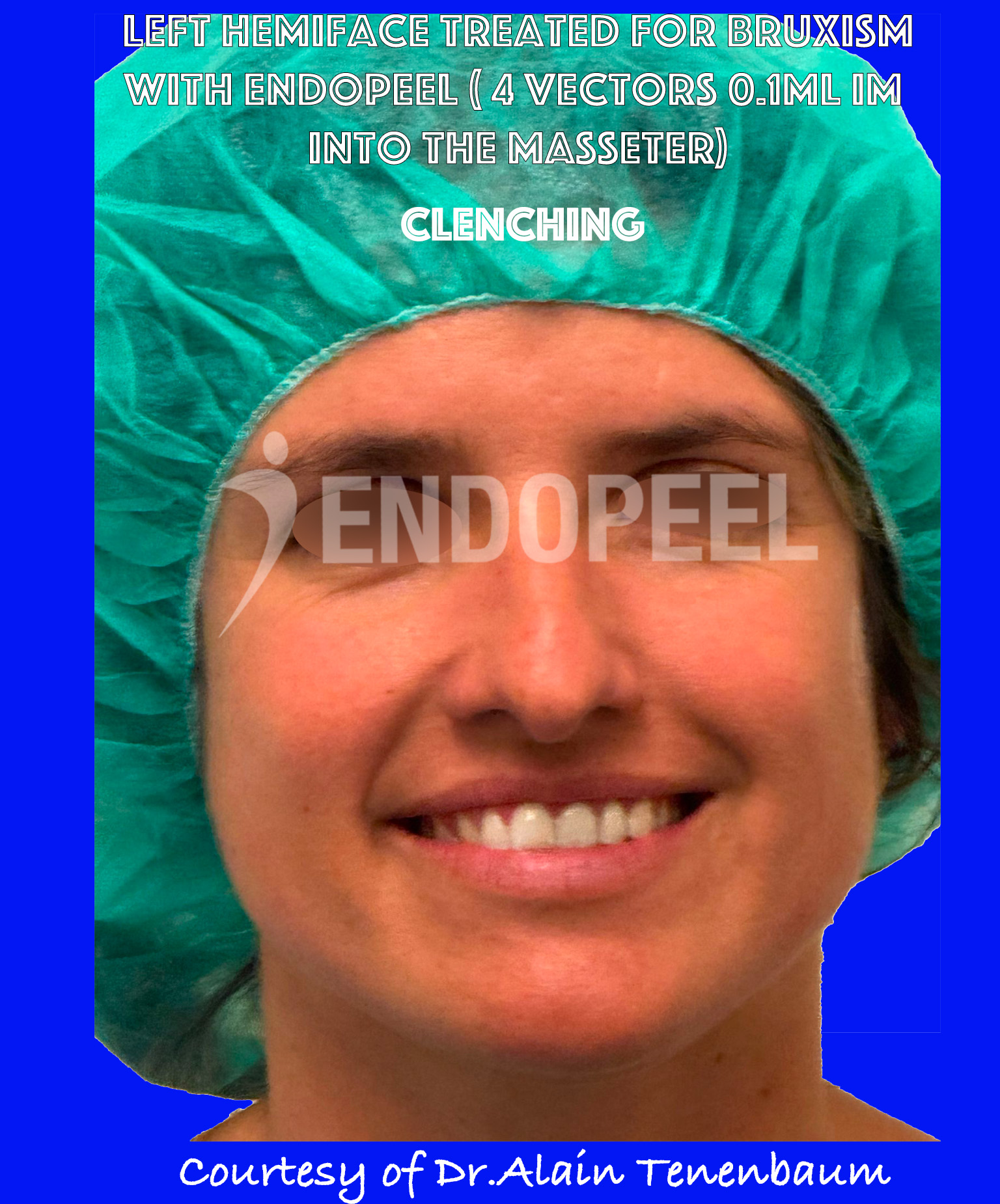 bruxism-clenching