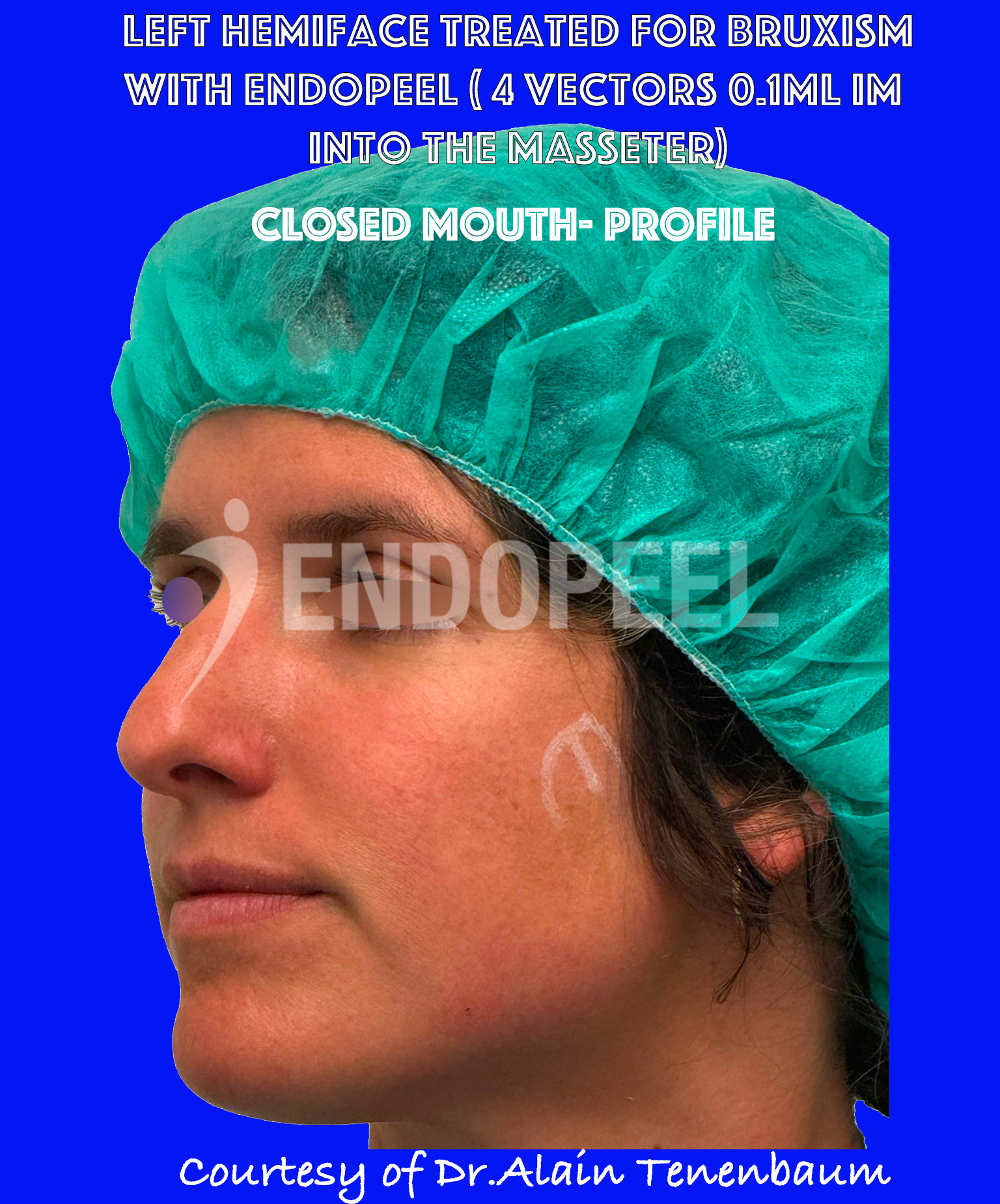 bruxism-closed-mouth-profile