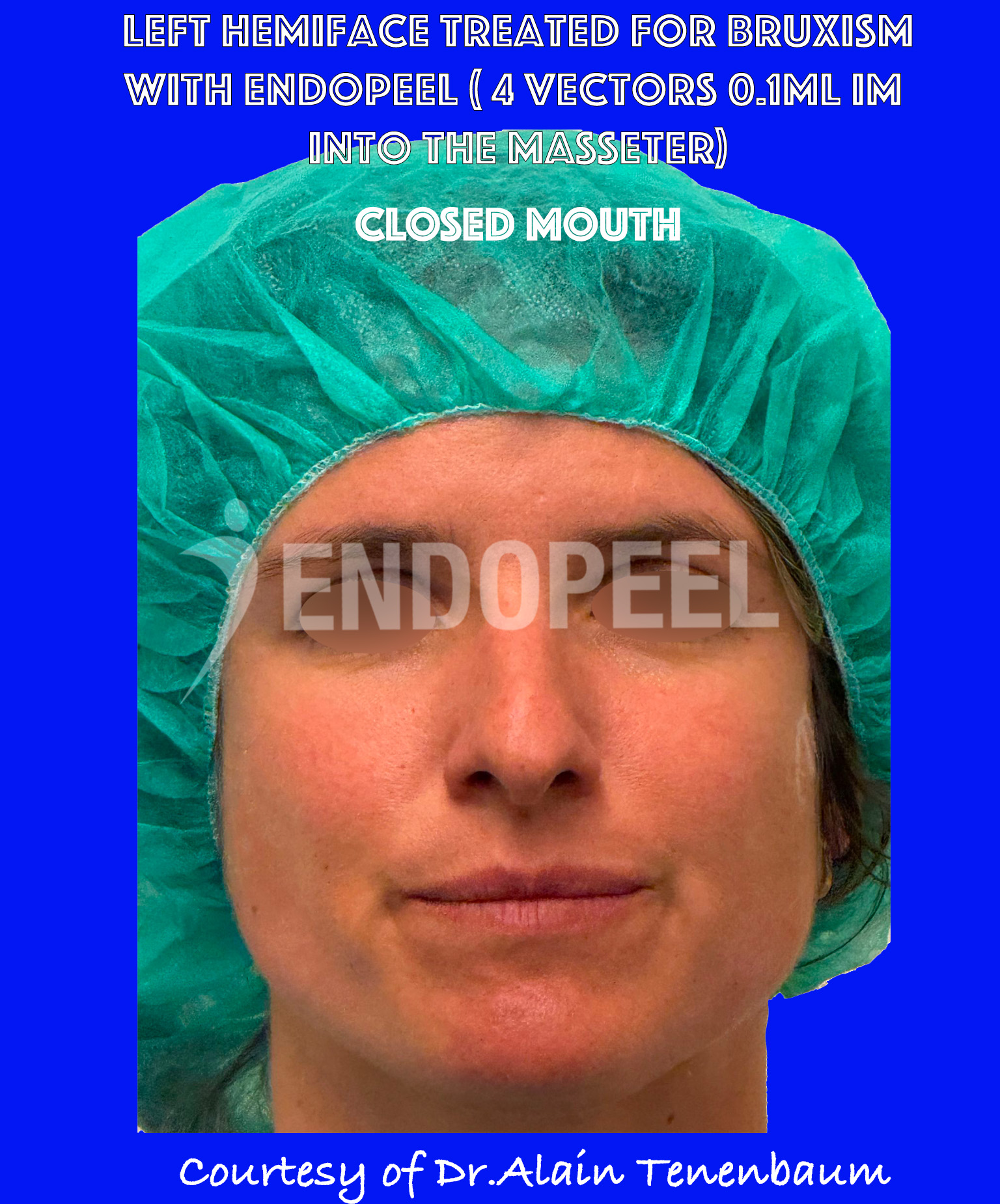 bruxism-closed-mouth